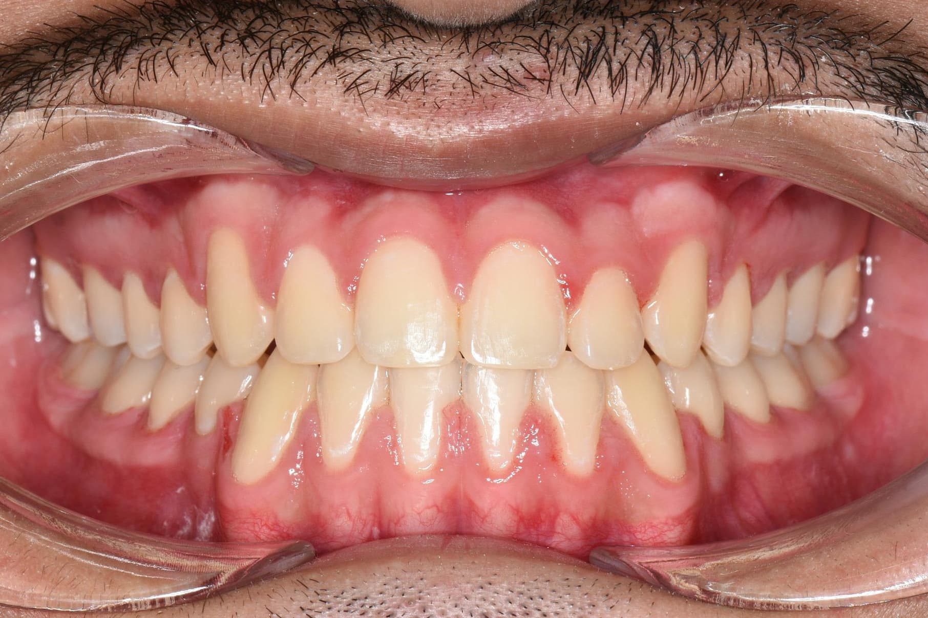 After braces treatment